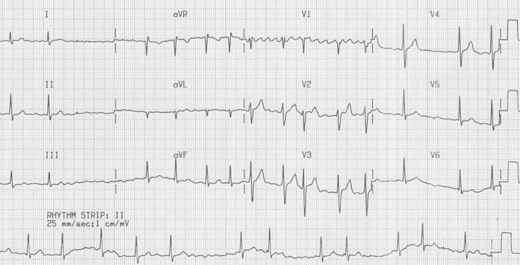 rung-nhi-dien-giai-lam-sang-ECG-Atrial-Fibrillation-coarse-flutter-waves-2-2